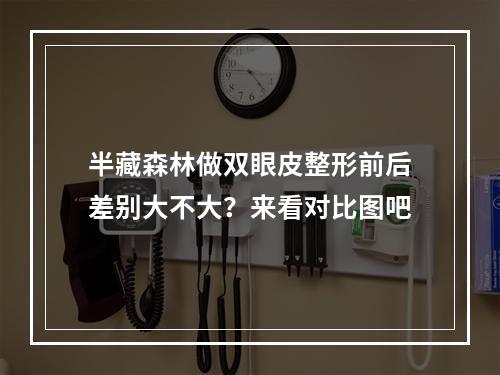 半藏森林做双眼皮整形前后差别大不大？来看对比图吧