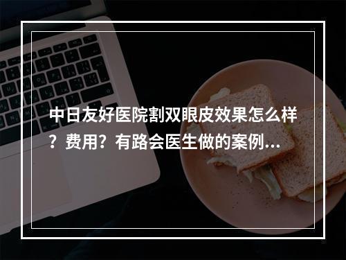 中日友好医院割双眼皮效果怎么样？费用？有路会医生做的案例分享！