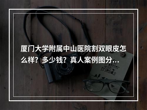 厦门大学附属中山医院割双眼皮怎么样？多少钱？真人案例图分享：小鹿无辜眼养成！