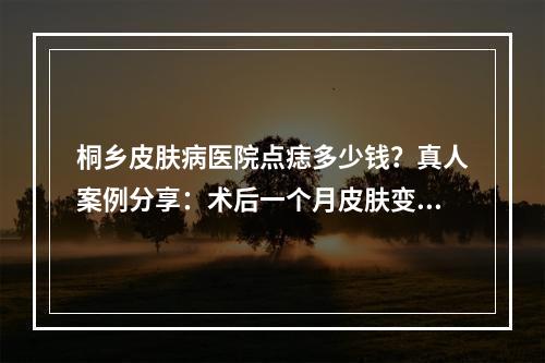 桐乡皮肤病医院点痣多少钱？真人案例分享：术后一个月皮肤变得细腻白皙了！