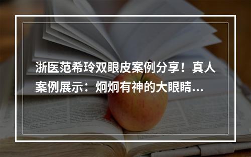 浙医范希玲双眼皮案例分享！真人案例展示：炯炯有神的大眼睛是真的香！