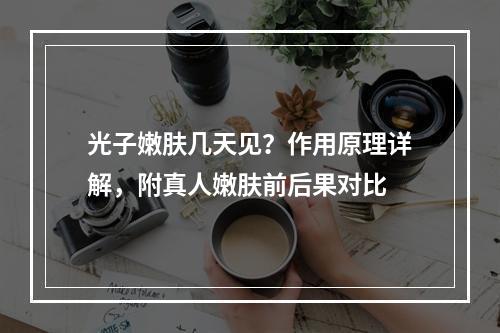 光子嫩肤几天见？作用原理详解，附真人嫩肤前后果对比