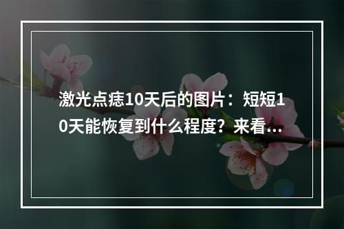 激光点痣10天后的图片：短短10天能恢复到什么程度？来看看