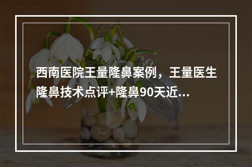 西南医院王量隆鼻案例，王量医生隆鼻技术点评+隆鼻90天近况展示