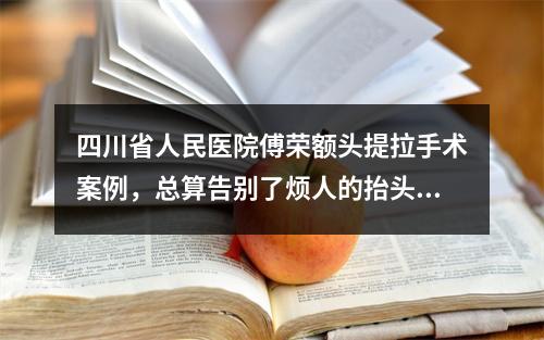 四川省人民医院傅荣额头提拉手术案例，总算告别了烦人的抬头纹！