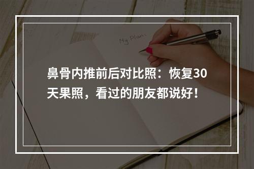 鼻骨内推前后对比照：恢复30天果照，看过的朋友都说好！