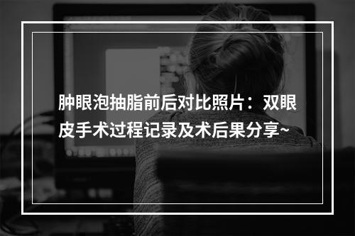 肿眼泡抽脂前后对比照片：双眼皮手术过程记录及术后果分享~