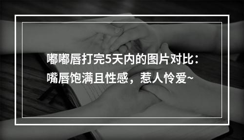 嘟嘟唇打完5天内的图片对比：嘴唇饱满且性感，惹人怜爱~