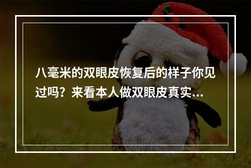 八毫米的双眼皮恢复后的样子你见过吗？来看本人做双眼皮真实案例图吧