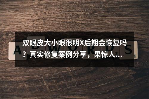 双眼皮大小眼很明X后期会恢复吗？真实修复案例分享，果惊人~