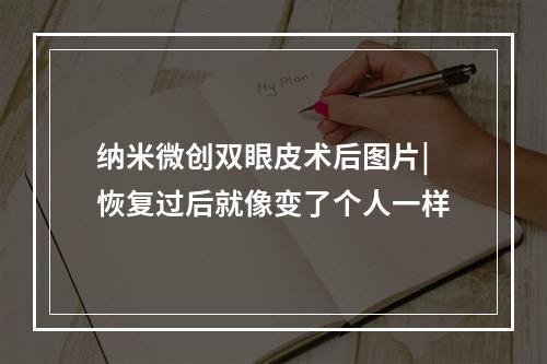 纳米微创双眼皮术后图片|恢复过后就像变了个人一样