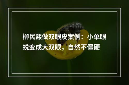 柳民熙做双眼皮案例：小单眼蜕变成大双眼，自然不僵硬