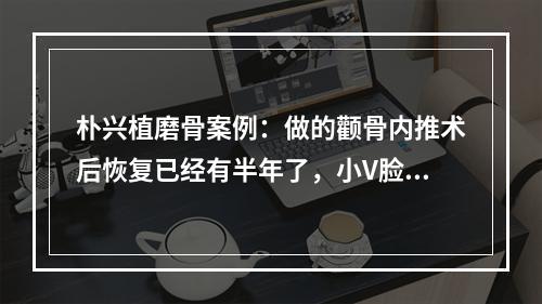 朴兴植磨骨案例：做的颧骨内推术后恢复已经有半年了，小V脸i了i了