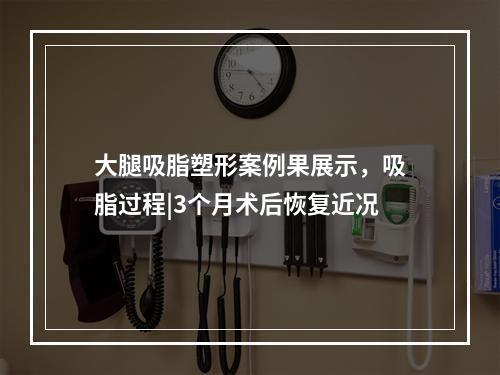 大腿吸脂塑形案例果展示，吸脂过程|3个月术后恢复近况