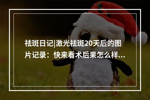 祛斑日记|激光祛斑20天后的图片记录：快来看术后果怎么样？