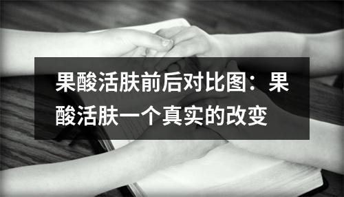 果酸活肤前后对比图：果酸活肤一个真实的改变