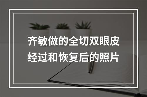 齐敏做的全切双眼皮经过和恢复后的照片