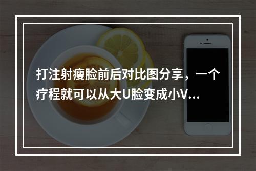 打注射瘦脸前后对比图分享，一个疗程就可以从大U脸变成小V脸啦