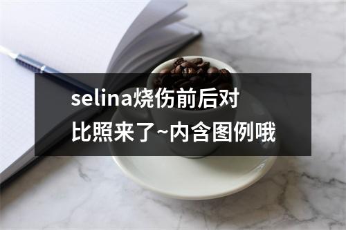 selina烧伤前后对比照来了~内含图例哦