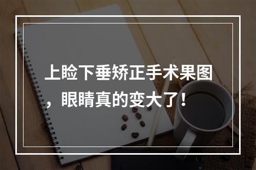 上睑下垂矫正手术果图，眼睛真的变大了！