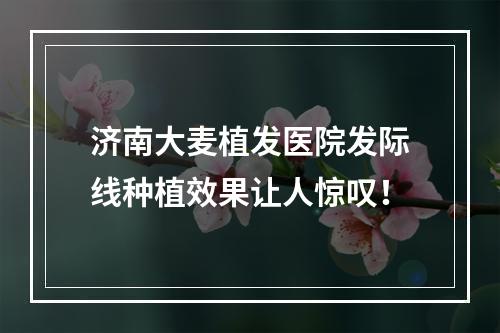 济南大麦植发医院发际线种植效果让人惊叹！