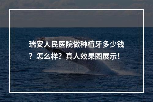 瑞安人民医院做种植牙多少钱？怎么样？真人效果图展示！