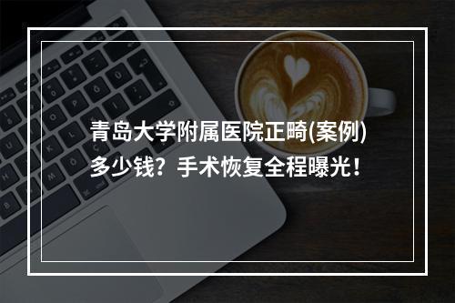 青岛大学附属医院正畸(案例)多少钱？手术恢复全程曝光！