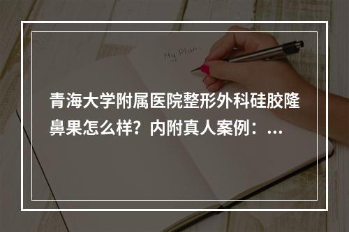 青海大学附属医院整形外科硅胶隆鼻果怎么样？内附真人案例：立体感这不就有了！