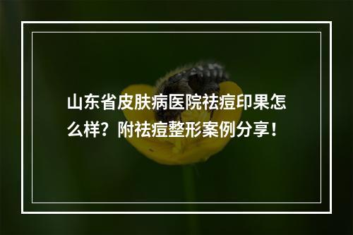 山东省皮肤病医院祛痘印果怎么样？附祛痘整形案例分享！