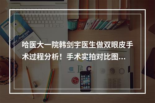 哈医大一院韩剑宇医生做双眼皮手术过程分析！手术实拍对比图哦