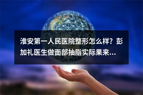 淮安第一人民医院整形怎么样？彭加礼医生做面部抽脂实际果来袭~