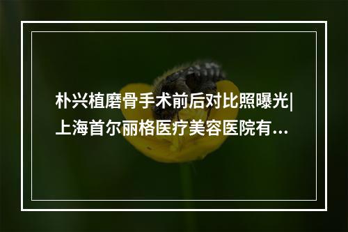 朴兴植磨骨手术前后对比照曝光|上海首尔丽格医疗美容医院有开展哪些项目？戳进来看详情