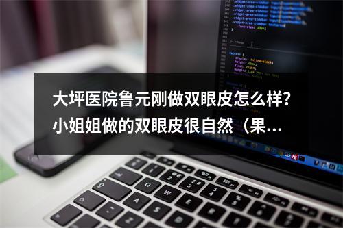 大坪医院鲁元刚做双眼皮怎么样？小姐姐做的双眼皮很自然（果图）