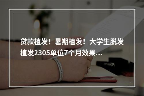 贷款植发！暑期植发！大学生脱发植发2305单位7个月效果图