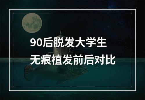 90后脱发大学生无痕植发前后对比