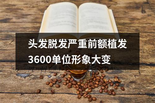 头发脱发严重前额植发3600单位形象大变