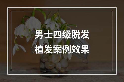 男士四级脱发植发案例效果