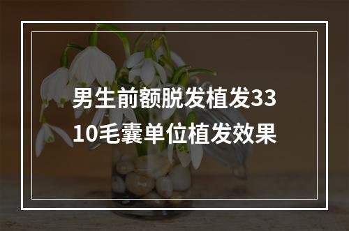 男生前额脱发植发3310毛囊单位植发效果