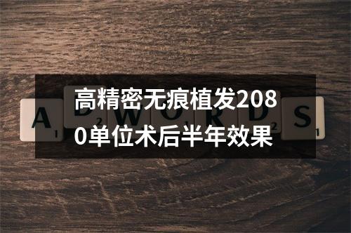 高精密无痕植发2080单位术后半年效果