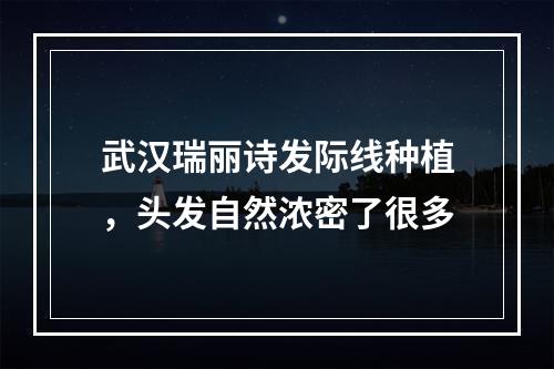 武汉瑞丽诗发际线种植，头发自然浓密了很多