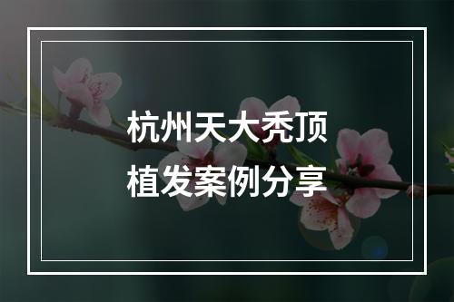 杭州天大秃顶植发案例分享