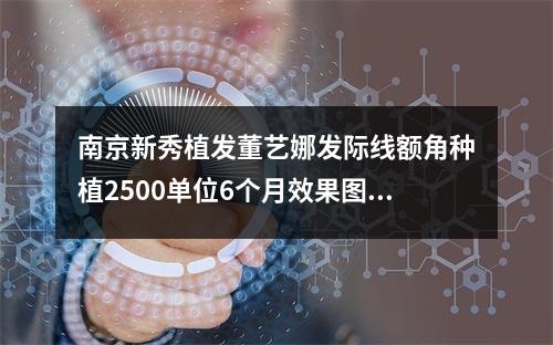 南京新秀植发董艺娜发际线额角种植2500单位6个月效果图来了