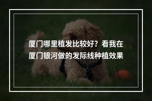 厦门哪里植发比较好？看我在厦门银河做的发际线种植效果