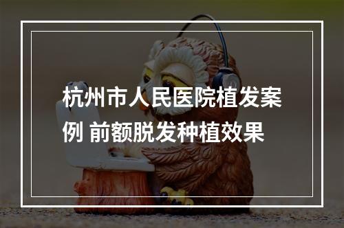 杭州市人民医院植发案例 前额脱发种植效果