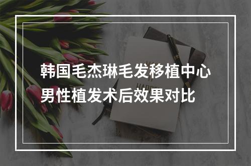 韩国毛杰琳毛发移植中心男性植发术后效果对比