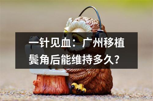 一针见血：广州移植鬓角后能维持多久？