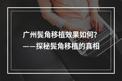 广州鬓角移植效果如何？——探秘鬓角移植的真相