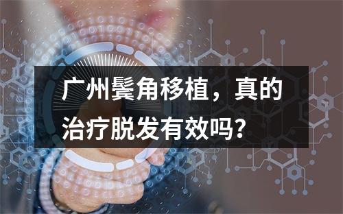 广州鬓角移植，真的治疗脱发有效吗？