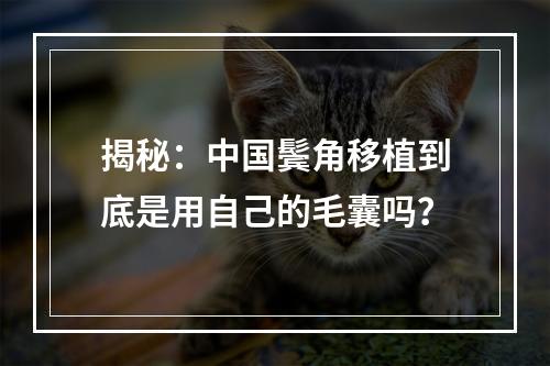 揭秘：中国鬓角移植到底是用自己的毛囊吗？