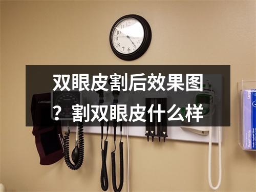 双眼皮割后效果图？割双眼皮什么样